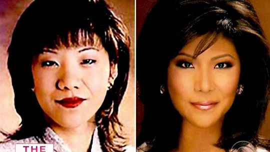chinese american woman eye lid surgery